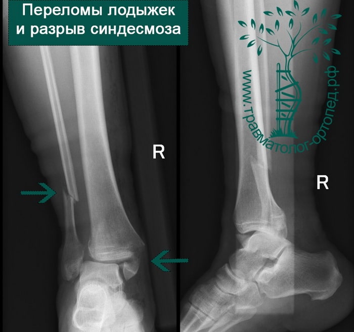 Реферат: Переломы лодыжек, повреждения голеностопного сустава